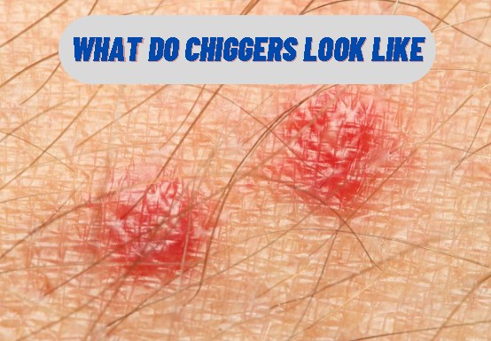 chigger bites